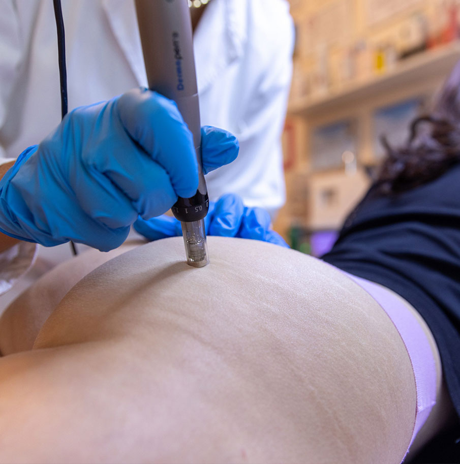 Needling smagliature