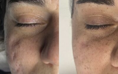 Giorgia ha effettuato dei trattamenti viso di Needling per migliorare le sue cicatrici post acne.