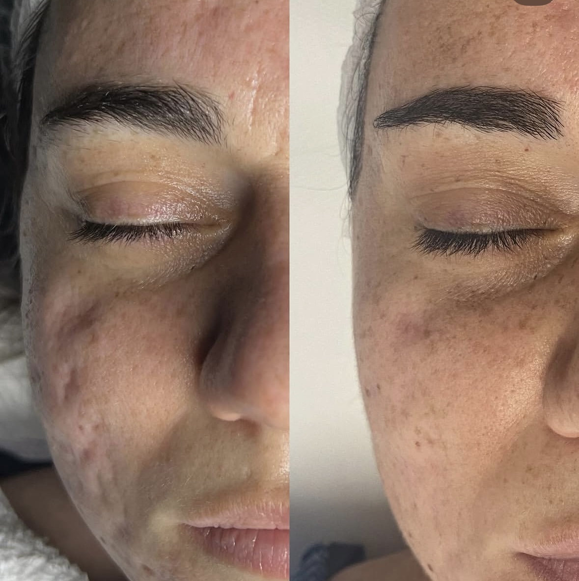 Giorgia ha effettuato dei trattamenti viso di Needling per migliorare le sue cicatrici post acne. Giorgia ha effettuato dei trattamenti viso di Needling per migliorare le sue cicatrici post acne