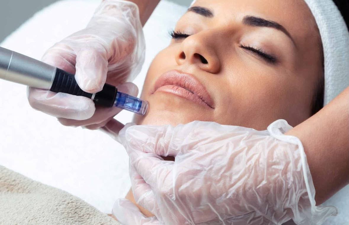 Micro Needling